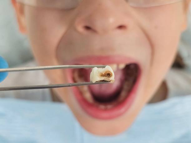 Best Emergency Dentist for Lost Fillings or Crowns in Strodes Mills, PA